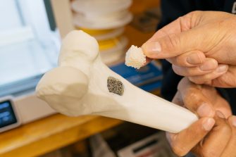 3D-printed implant that could transform how doctors treat fractures and bone injuries