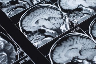 magnetic resonance, neuroimaging of the human brain