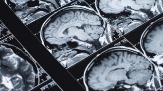 magnetic resonance, neuroimaging of the human brain