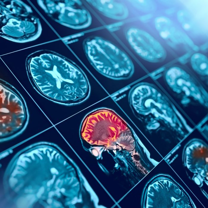 MRI film of human brain with red marked zone, healthcare background.