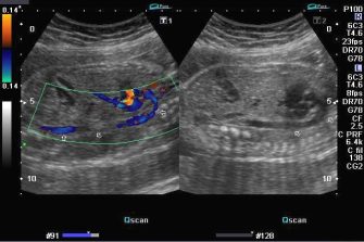 Doppler image of fetal aorta © Dr. Joe Antony