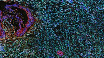 Pancreatic desmoplasia