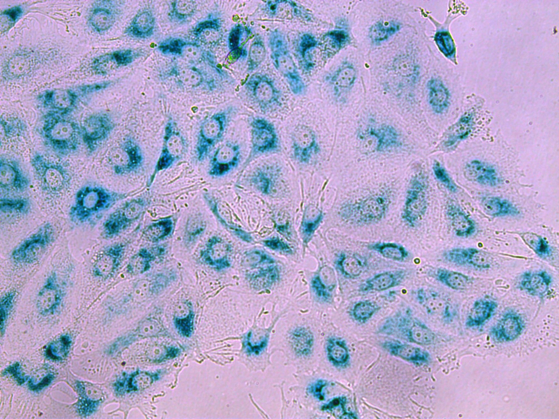 Breast cancer cells in their 'sleeping' state (senescence) after treatment. When the JNK pathway is disrupted, cancer cells fail are less likely to enter this state and continue dividing, leading to therapy resistance.