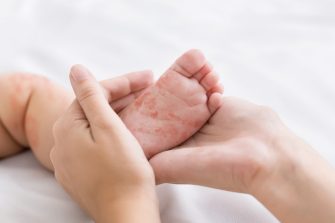 Measles virus. Mother holding tiny baby foot with red rash, closeup